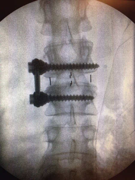 An interbody graft is placed in the spinal column using a technique known as Oblique Lumbar Interbody Fusion.