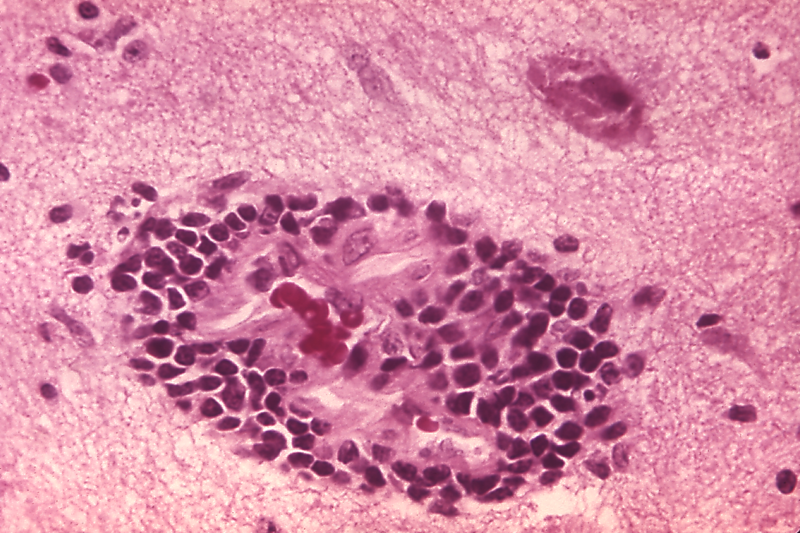 This micrograph depicts the histopathologic changes associated with rabies.