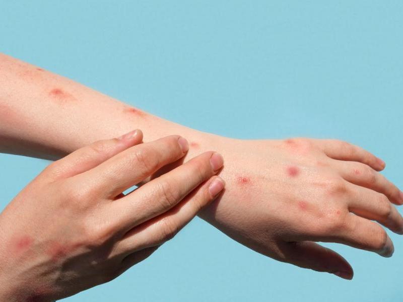 The case is isolating at home and does not require hospitalization. CDC photo