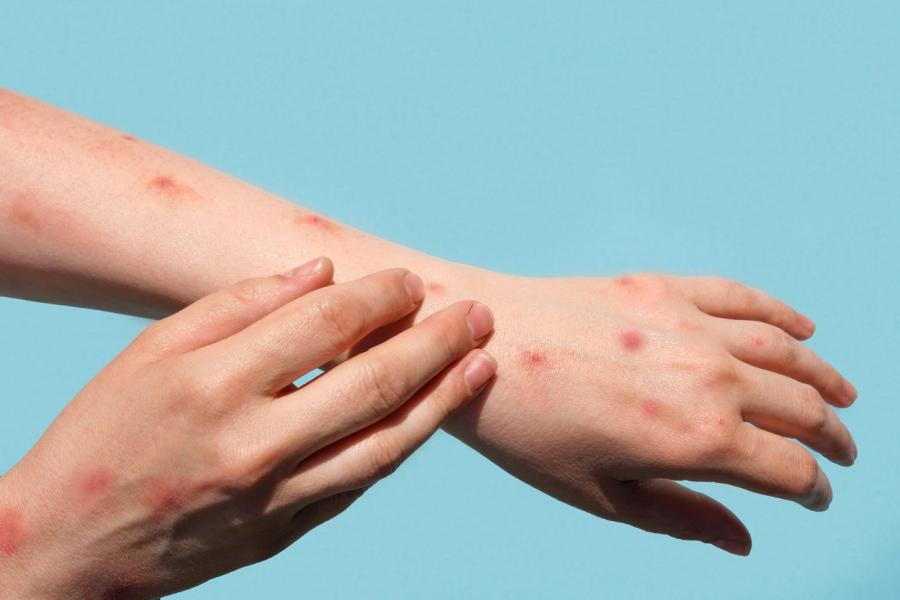 The case is isolating at home and does not require hospitalization. CDC photo
